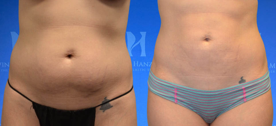 Liposuction View 1_1