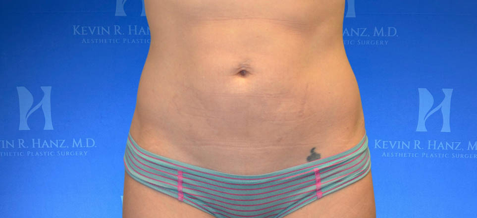 Liposuction View 1_2