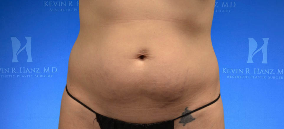 Liposuction View 1_3