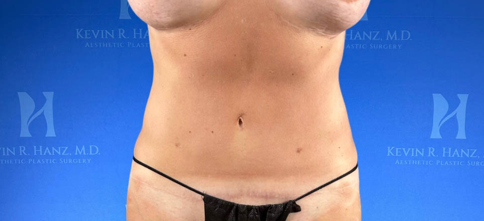 Liposuction View 28_10