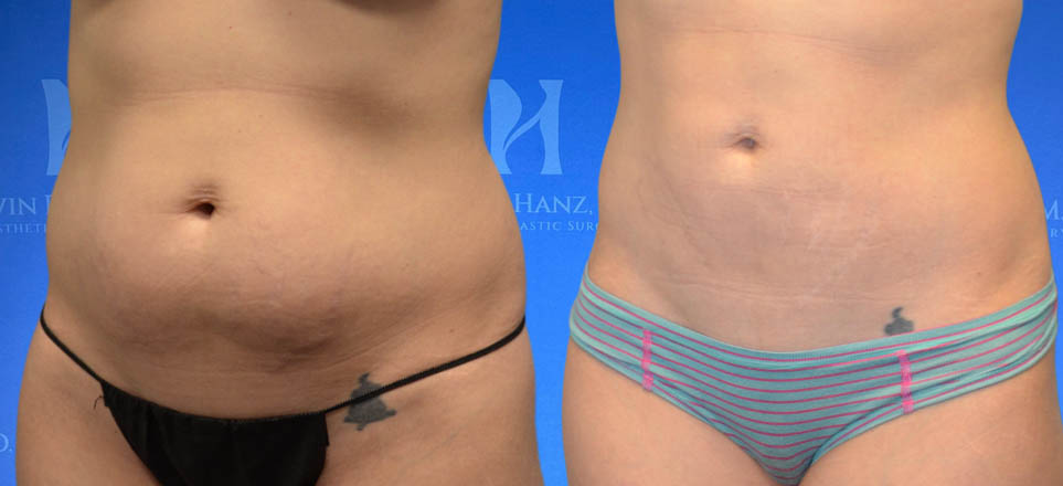 Liposuction View 1_4