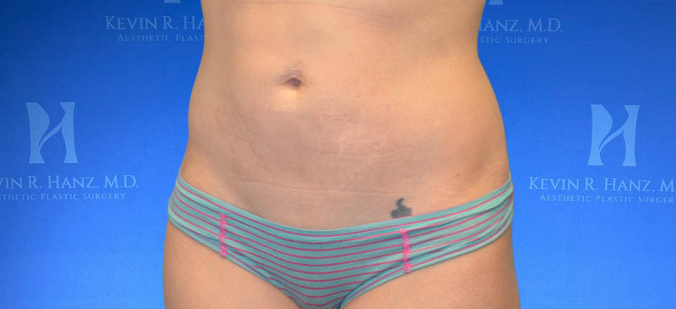 Liposuction View 1_5