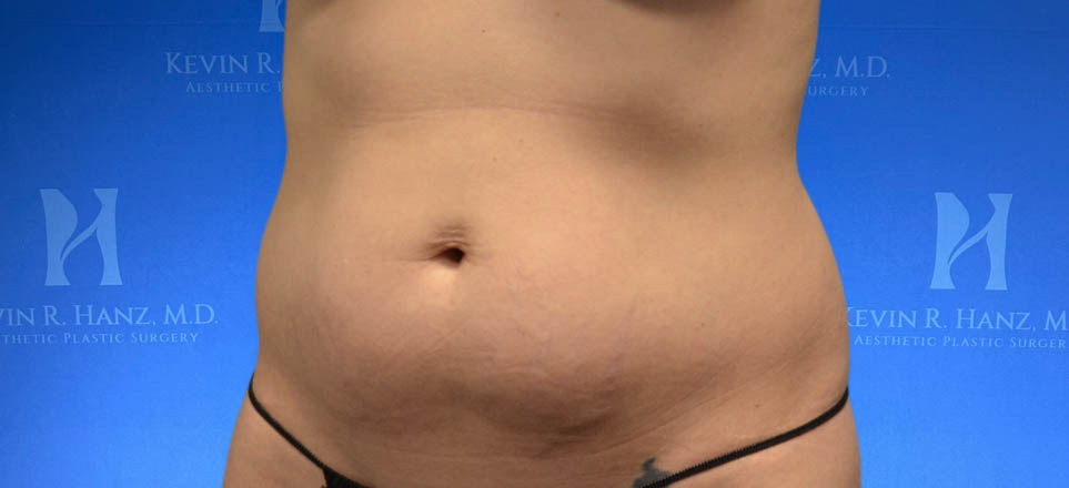 Liposuction View 1_6