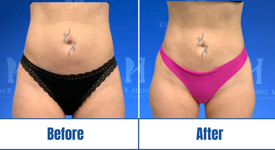 Liposuction 360