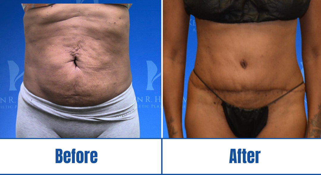 Abdominoplasty