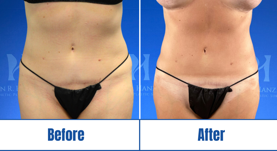 Liposuction 360