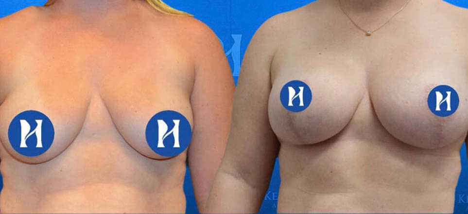 Breast Augmentation