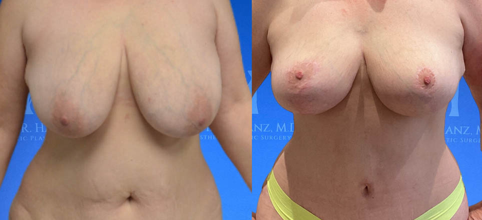 Breast Lift