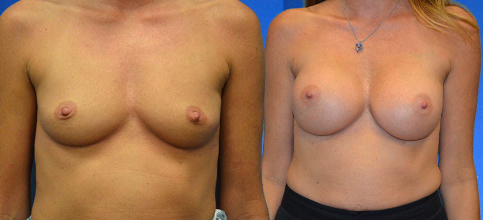 Breast Augmentation