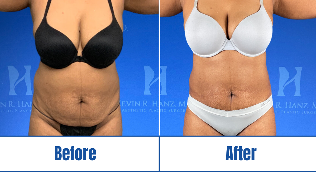 Liposuction