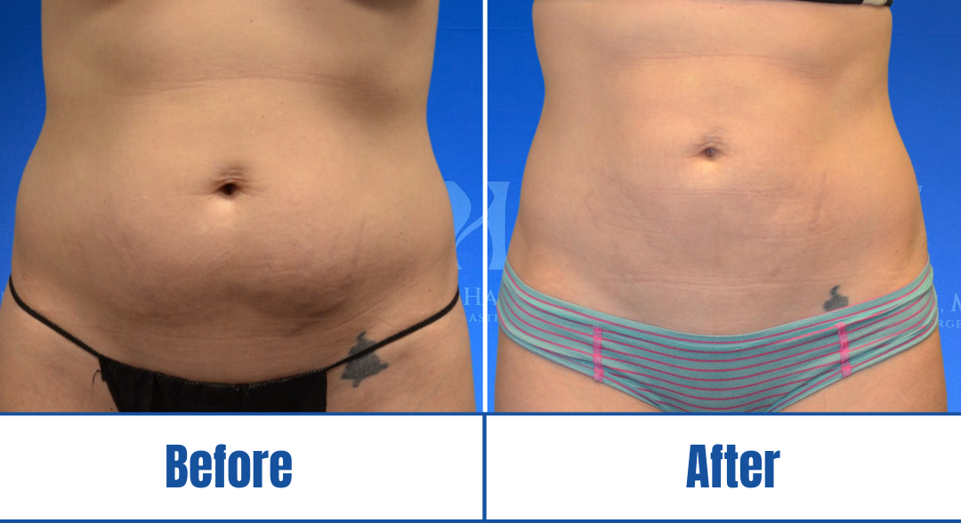 Abdominoplasty