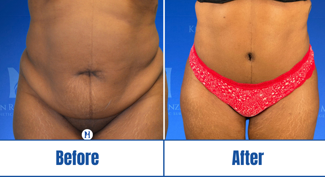 Abdominoplasty