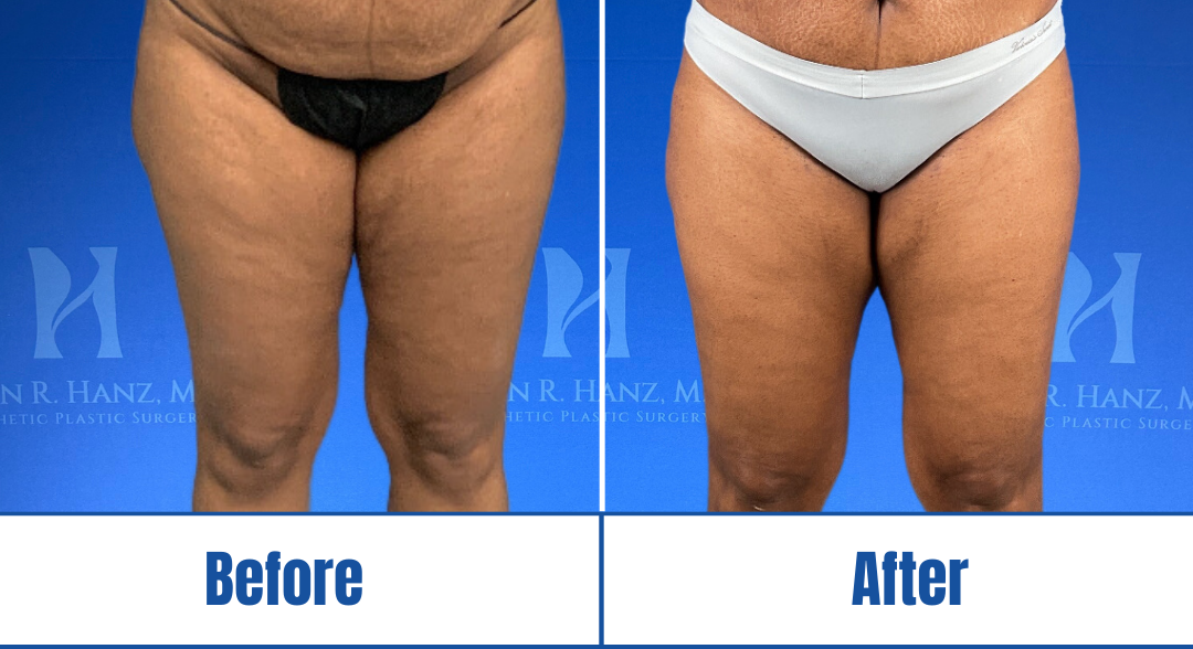 Liposuction