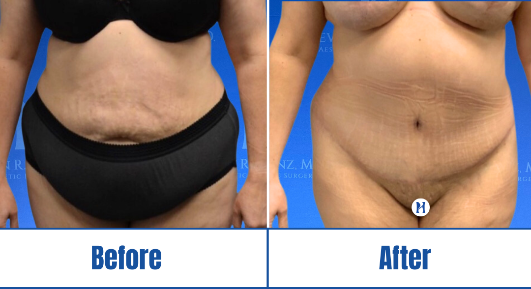 Abdominoplasty