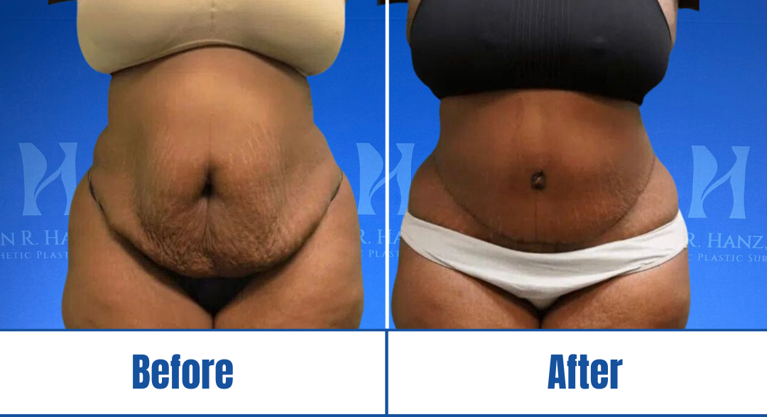 Abdominoplasty