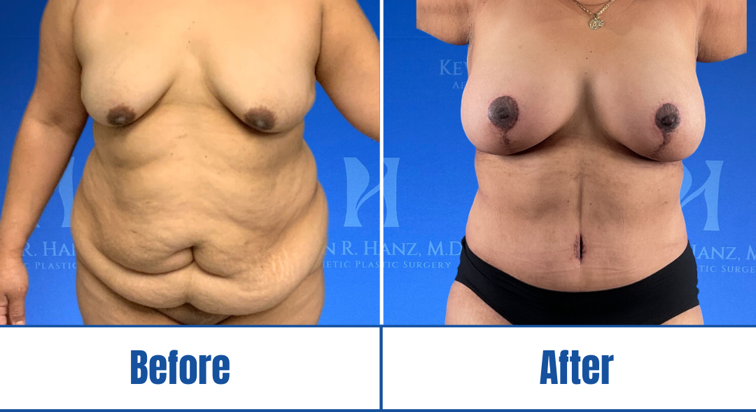 Abdominoplasty