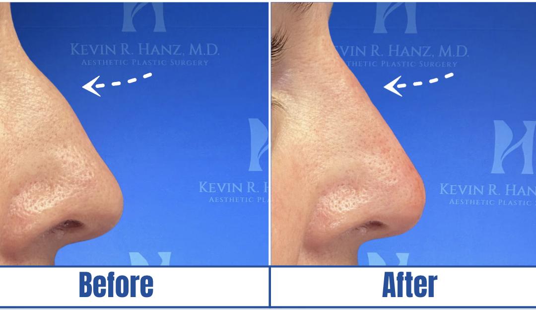 Liquid Rhinoplasty