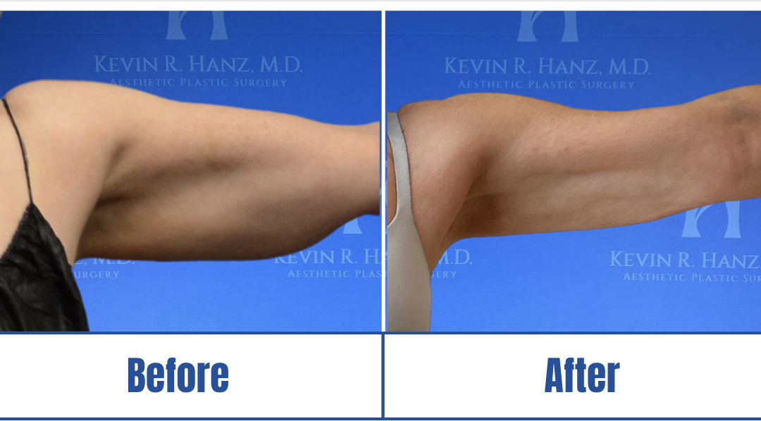 Liposuction: Arms