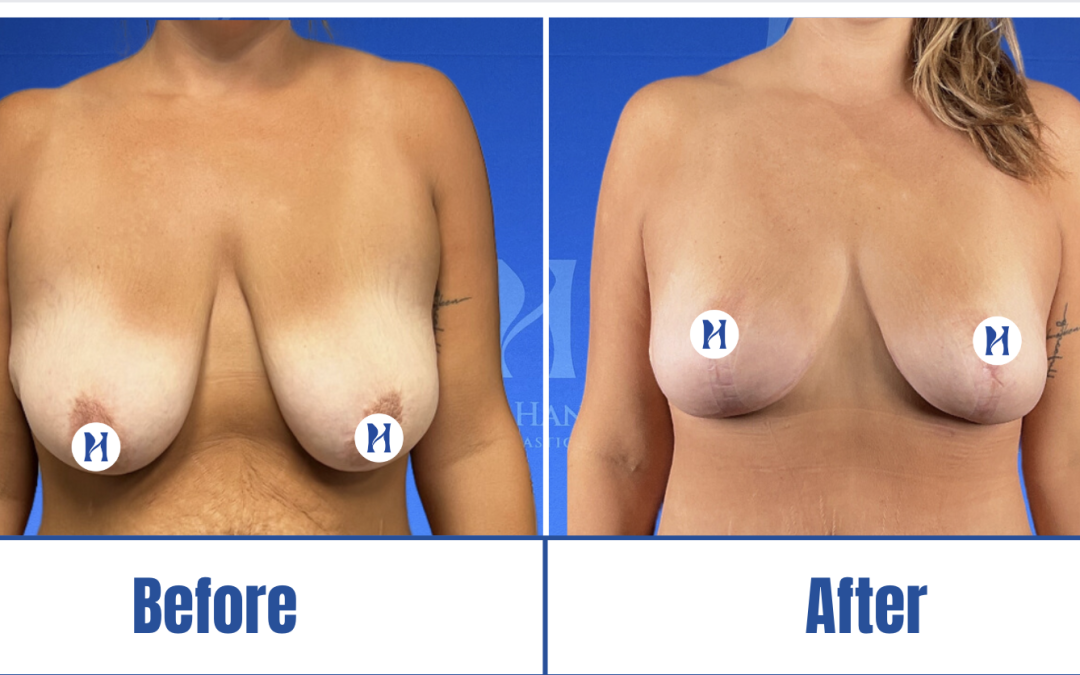 Breast Lift