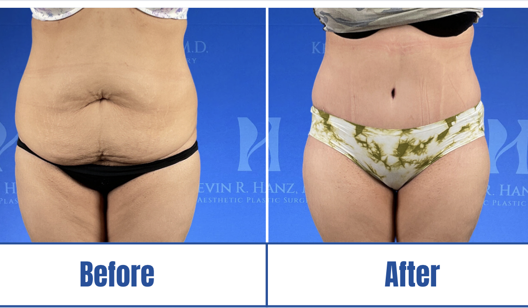 Abdominoplasty