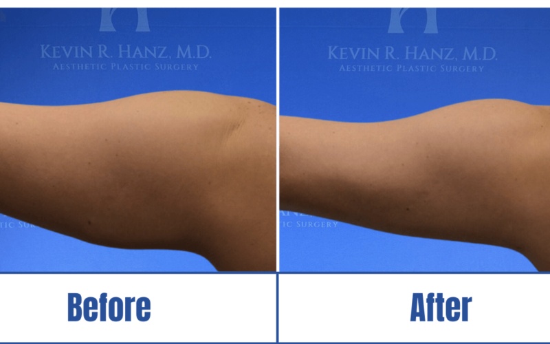 Body Contouring Before and After results of a woman in Dallas, TX