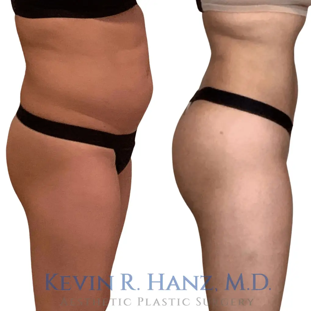 Before and after of Brazilian butt lift at Kevin R. Hanz Aesthetic Plastic Surgery in Dallas, TX