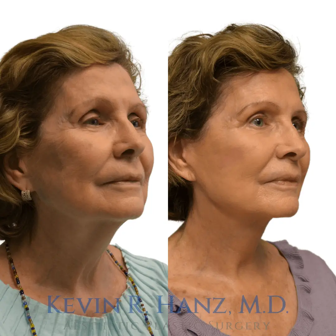 Kevin R. Hanz Aesthetic Plastic Surgery facelift procedure before and after