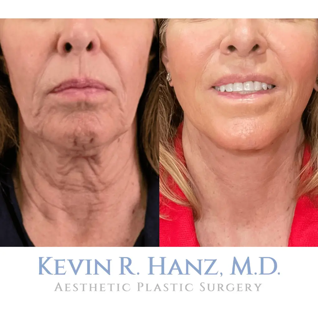 Before and after of facelift at Kevin R. Hanz Aesthetic Plastic Surgery in Dallas, TX