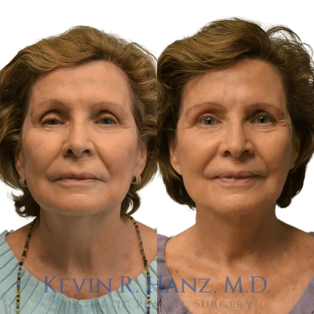 Before and after photos of neck and face lift surgery on a mature woman