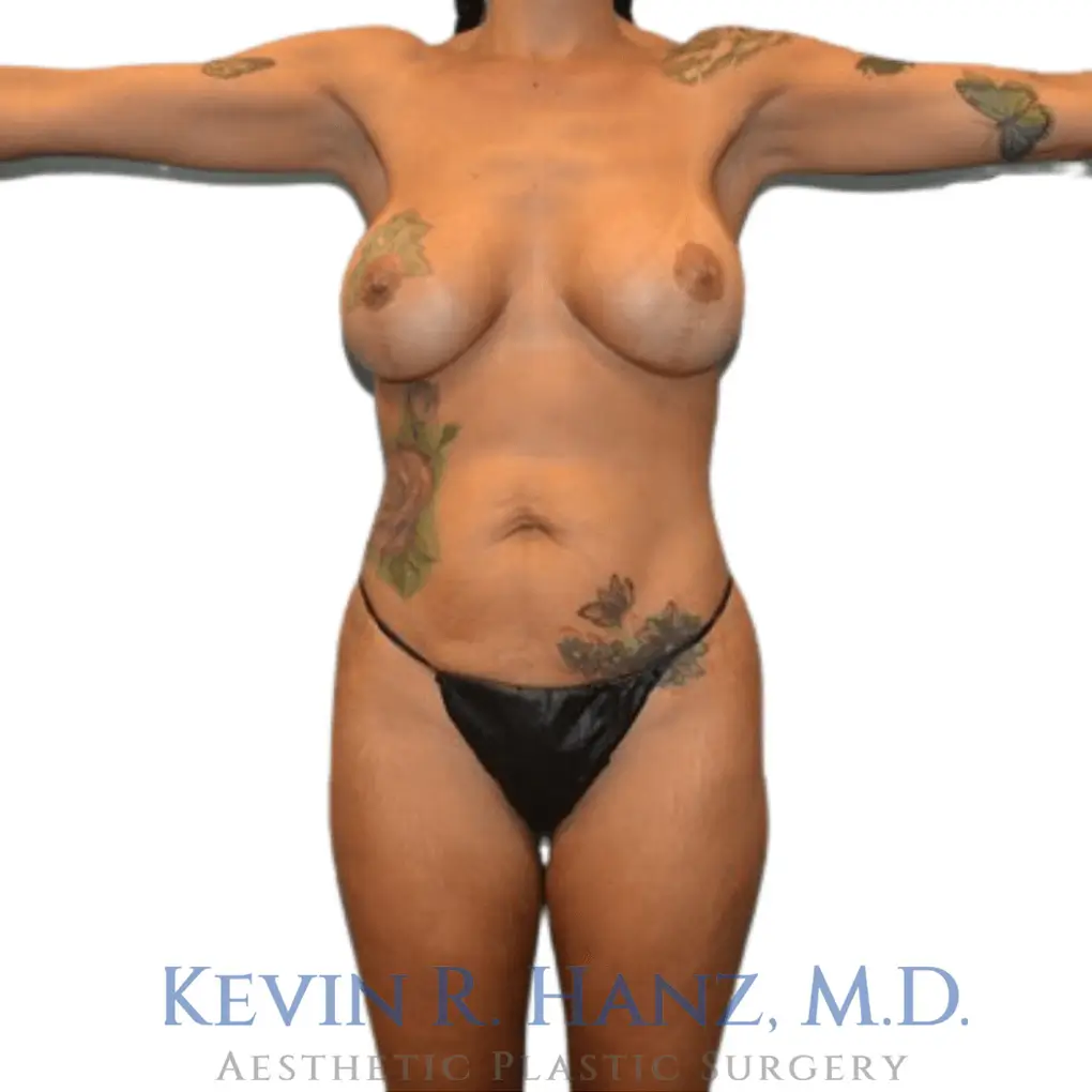 Kevin R Hanz MD after photo of mommy makeover procedure