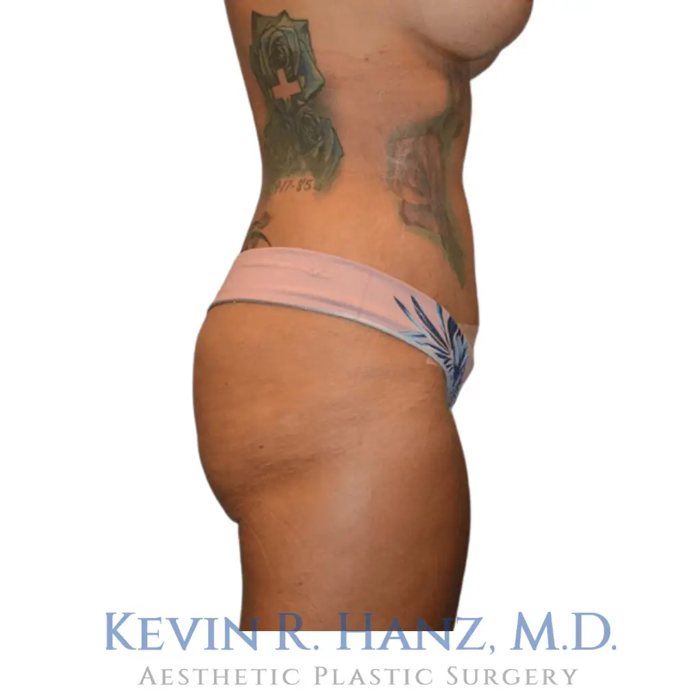 Post-liposuction procedure on a woman's stomach area