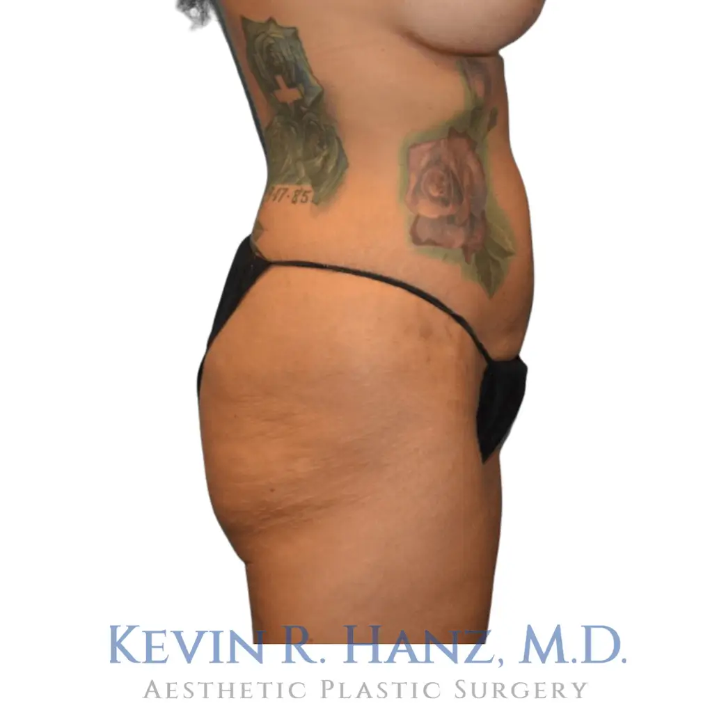 Profile view of after a womans body contouring surgery at Kevin R Hanz MD