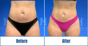 Before and after woman's liposuction at Dr. Kevin R Hanz Aesthetic Plastic Surgery in Dallas-Fort Worth