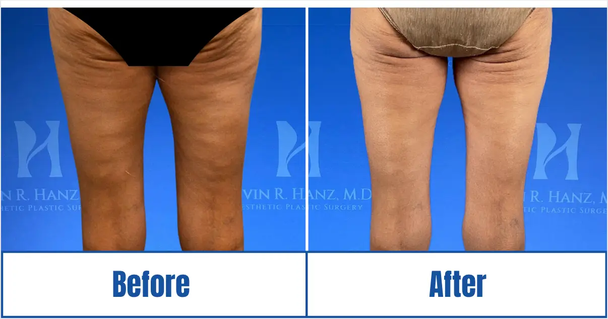 Woman's glute fat removal at Kevin R. Hanz Aesthetic Plastic Surgery in Dallas-Fort Worth