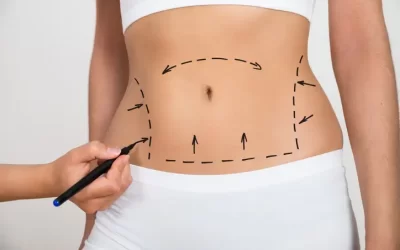 What Areas of the Body Can Be Treated with Liposuction?