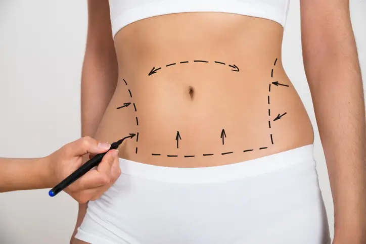 What Areas of the Body Can Be Treated with Liposuction?