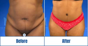 Abdominoplasty before and after of a woman
