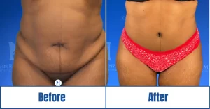 Abdominoplasty surgery in Dallas, TX<br />
