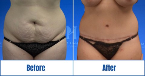 Before & after image of a woman who got Abdominoplasty in Dallas Fort Worth