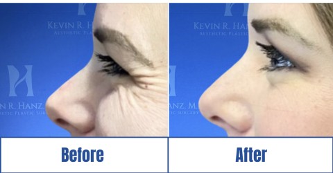 Before & after image of a woman who got Botox: Under Eye treatment in Dallas Fort Worth