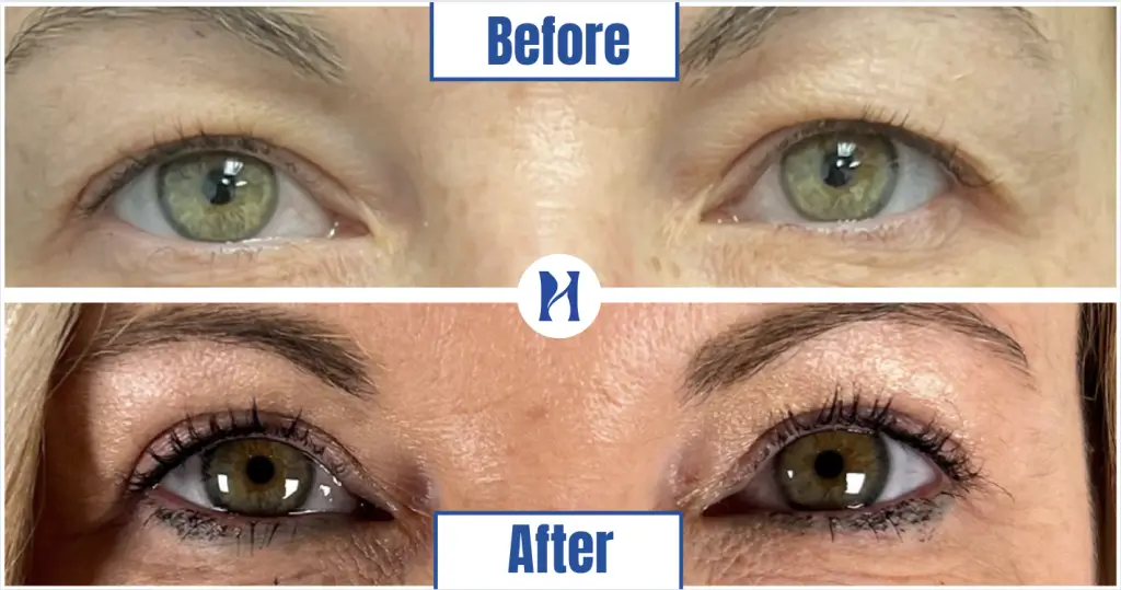 Before and after eyelid lift