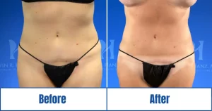 Before and after Liposuction 360<br />
