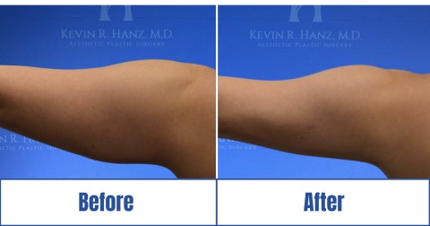 Before & after image of a patient's hand who got Liposuction surgery in Dallas Fort Worth