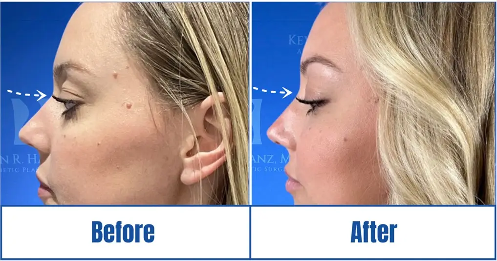 Before and after rhinoplasty surgery