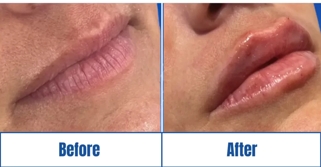 Before and after lip fillers of 30-40-year-old woman