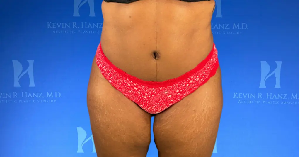 Woman after abdominoplasty