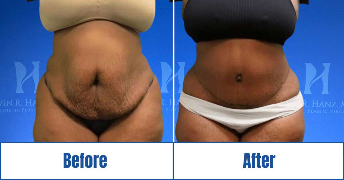 Before and After View of Abdominoplasty Treatments in Dallas, TX
