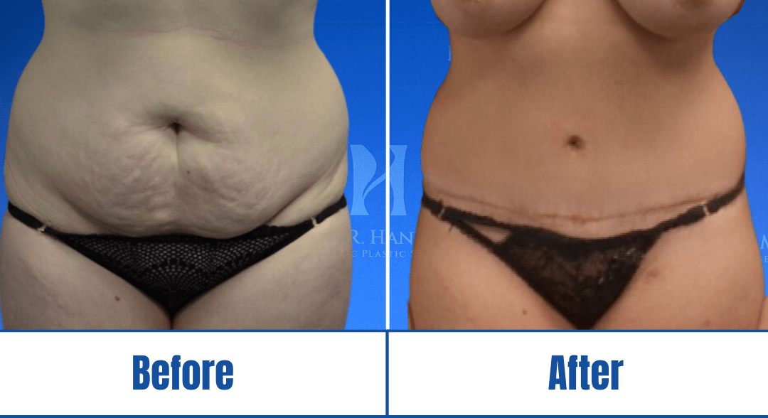 Abdominoplasty #2