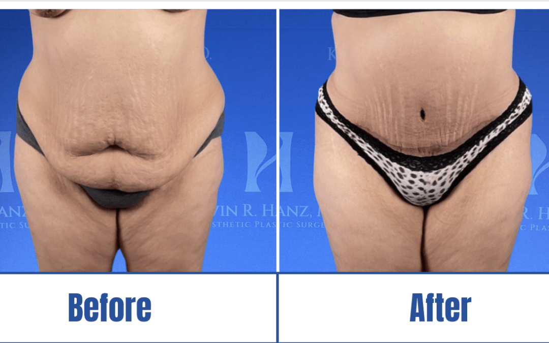A woman's tummy showcasing the before and after of abdominoplasty surgery results in Dallas, TX.