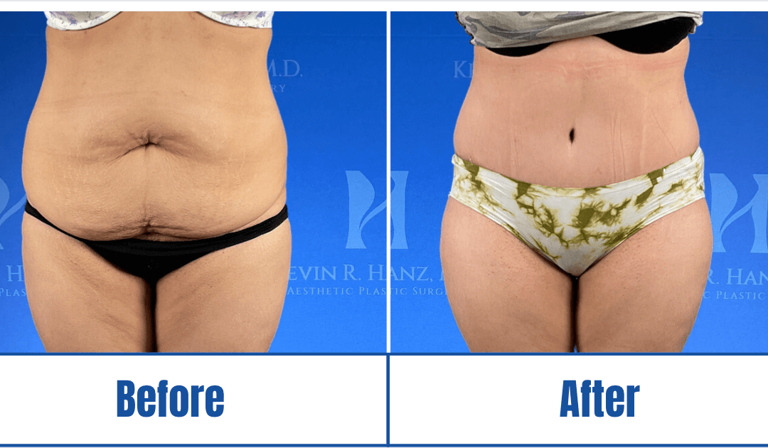 Abdominoplasty